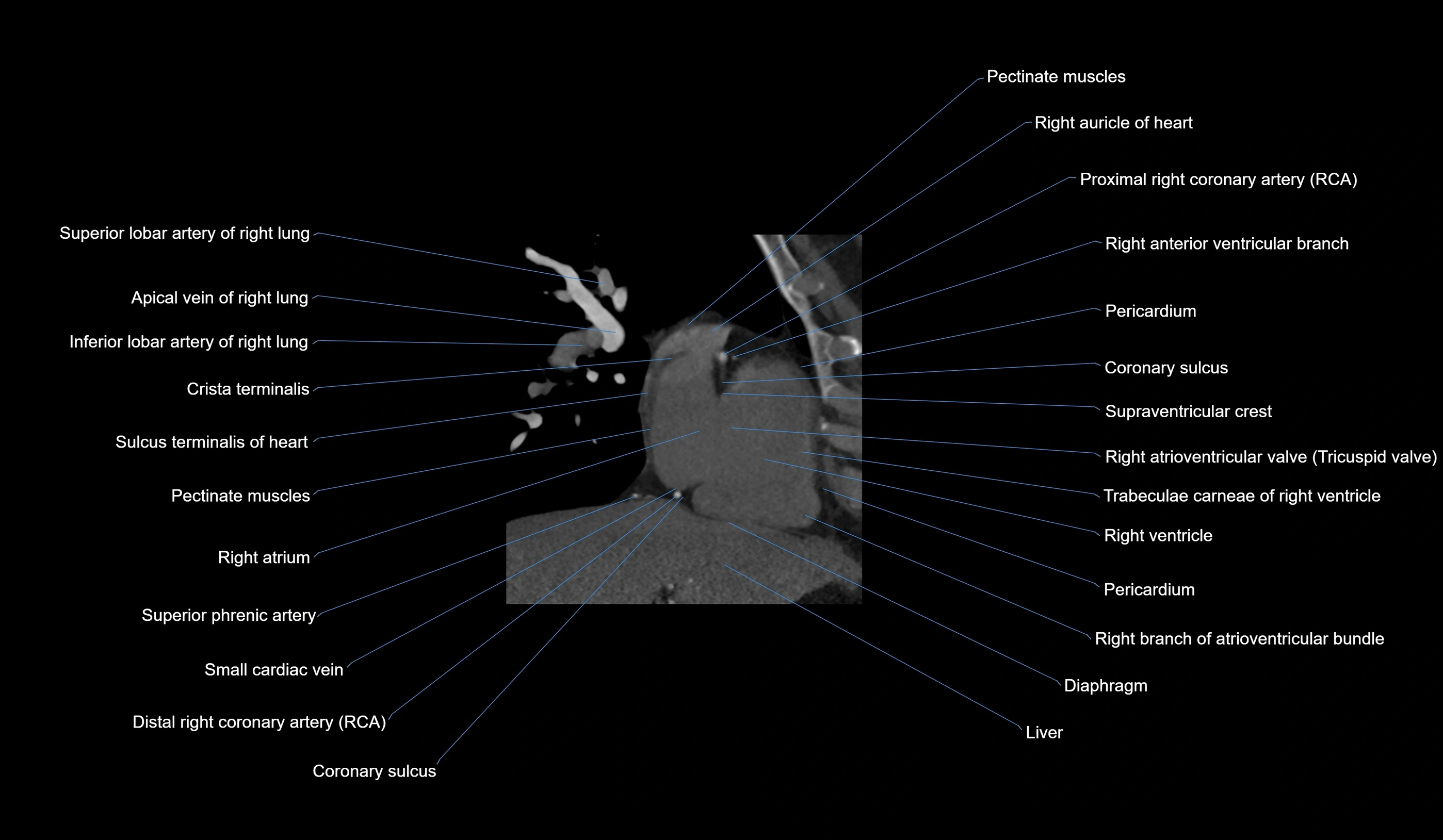 CT heart (coronary angiogram) 2 chamber view cross sectional anatomy labelled radiology image-00033.webp